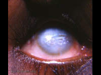 interstitial keratitis with band-shaped keratopathy
