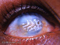 bandshaped keratopathy