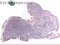 Basal Cell Carcinoma, nodular tyle