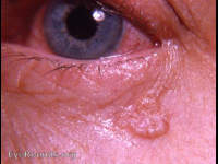 Basal cell carcinoma