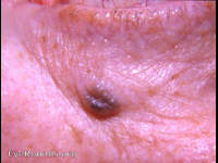 Basal cell carcinoma