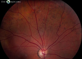 Congenital hypertrophy of the retinal pigmented epithelium (CHRPE) in a "bear tracks" configuration