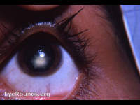 Bee sting keratopathy