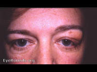 benign lymphocytic infiltration of lacrimal gland, left eye