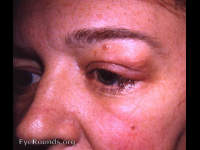 benign lymphocytic infiltration - lacrimal gland