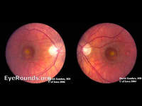 Best Vitelliform Macular Dystrophy