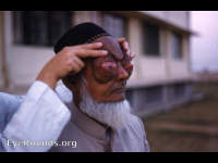 Bilateral orbital lymphomata