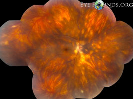 Birdshot Chorioretinopathy
