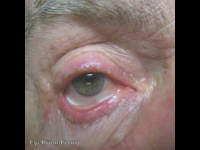 blepharitis and meibomian gland dysfunction