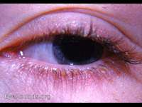 blepharitis marginalis, typical
