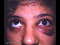 blowout fracture right eye with muscle entrapment