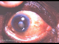 coloboma of iris - a special bridge variety-with a mature corticonuclear cataract
