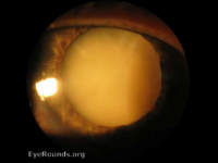 Brunescent cataract, mature