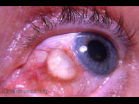bulbar conjunctival epithelial inclusion cyst