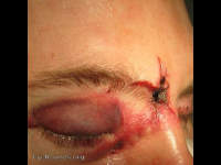 CSF leak from gun shot wound to the head