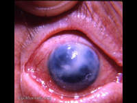 bullous keratopathy following intracapsular cataract surgery