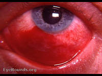 traumatic subconjunctival hemorrhage