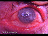 burns of lid margin and superficial cornea
