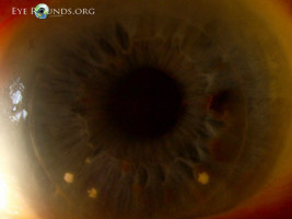 Graft-host interface candida infection after descemet stripping automated endothelial keratoplasty