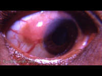 carcinoma of the conjunctiva
