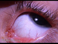 anatomical anomaly of caruncula lacrimalis