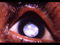 cataracta calcarea, calcified cataract