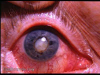 Cataracta complicata with chronic uveitis