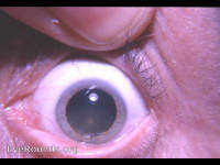 cataracta syndermatotica or cataracta neurodermatica: associated with atopic dermatitis