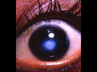 central corneal leukoma