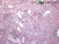 chalazion