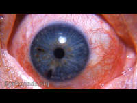 Chalcosis