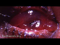 chemosis - marked edema of the bulbar conjunctiva following evisceration