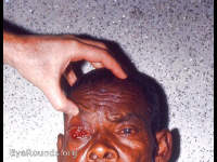 conjunctiva: marked chemosis, right eye