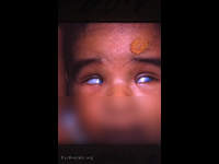 Chickenpox teratogenesi
