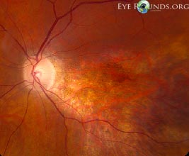 Chloroquine retinal toxicity