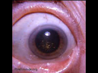 cholesterol crystals in lens