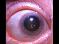 cataract: cholesterol crystals