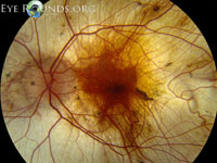 Choroideremia