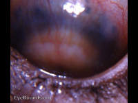 anterior ectasiae/anterior scleral staphlomata