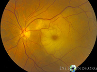 Cilioretinal artery occlusion