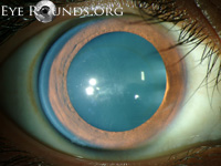 Classic Fleischer Ring in keratoconus