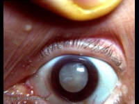 Many patients who came to the Kurji Holy Family Hospital Eye Clinic were described as having " two headlights in their eyes " - a pure white pupil in each eye. The differential lay between the more frequent hypermature Morgagnian cataract and the less frequent intumescent cataract. The intumescent cataract has prominent sectorial markings in the anterior cortex. The hypermature Morgagnian cataract has absolutely no sectorial markings in its completely liquefied anterior cortex. It should be mentioned that many patients presented with a dirty-white pupil. That usually meant a mature senile catarct. A pure-black pupil due to cataract suggested a nuclear cataract. In India, the cataracta nigra was occasionally seen. Before the use of the slit-lamp the cataracta nigra was frequently not recognized as the cause of the patient's blindness - the pupil appeared to be normally black.