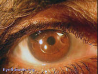 Artisan(claw) intraocular lens