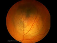 Malignant melanoma of the choroid - mushroom shaped configuration