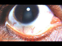 Coloboma of iris