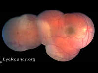 commotio retinae