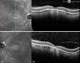 Cone-rod dystrophy