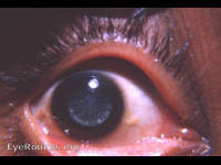 coronary cataract / cataracta coronaria