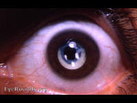 congenital cataract, membranous cataract stage