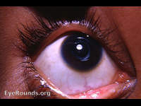 congenital cataract - post-op extracapsular cataract surgery